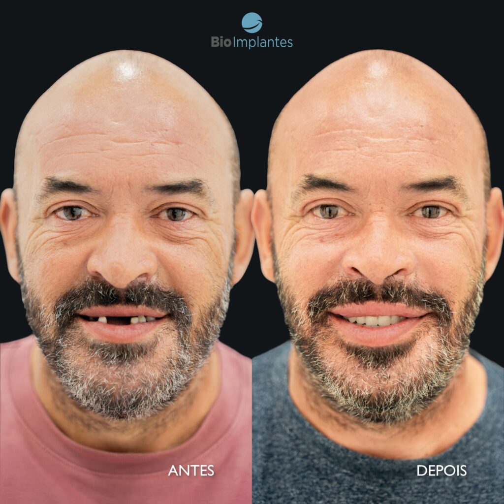 Dentes fixos num Dia