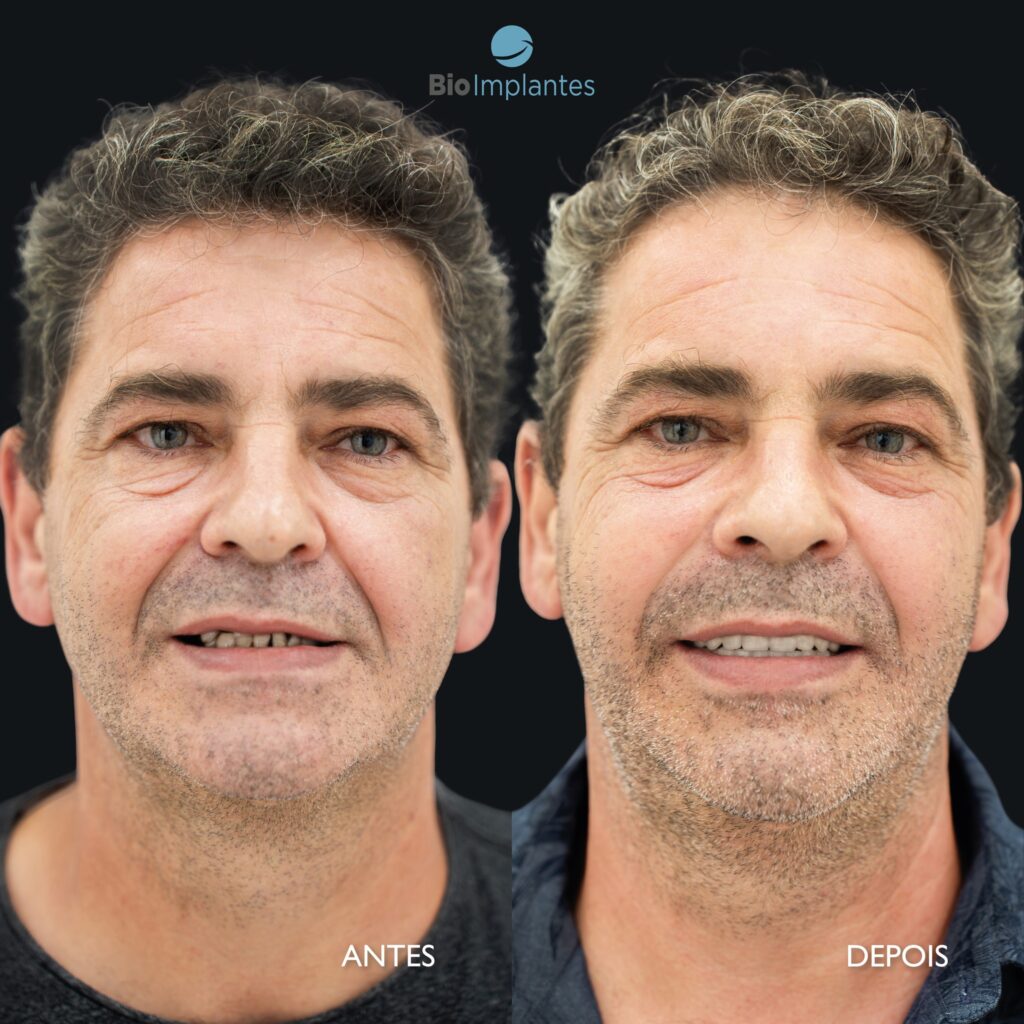 prótese fixa sobre implantes